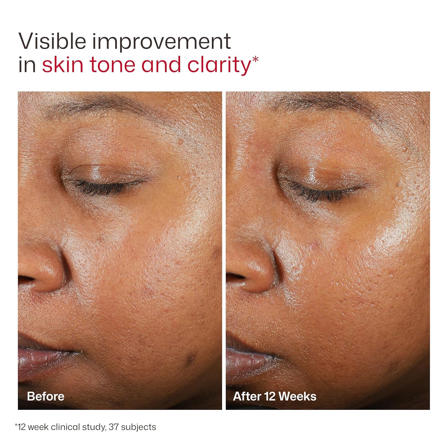 EltaMD UV Clear Face Sunscreen SPF, Oil-Free Sunscreen with Zinc Oxide, Dermatologist Recommended