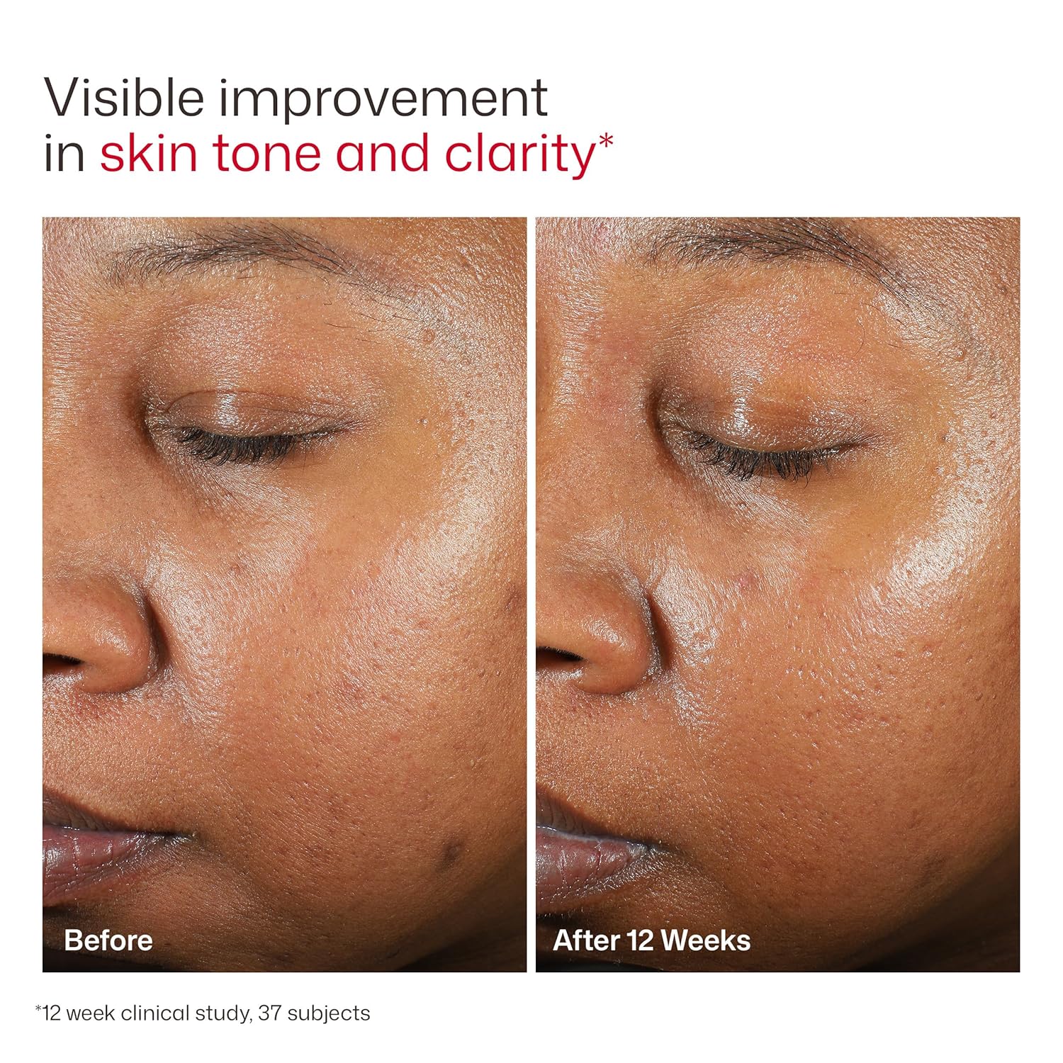 EltaMD UV Clear Face Sunscreen SPF, Oil-Free Sunscreen with Zinc Oxide, Dermatologist Recommended